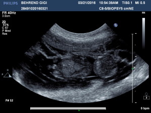 032116 Gigi Ultrasound